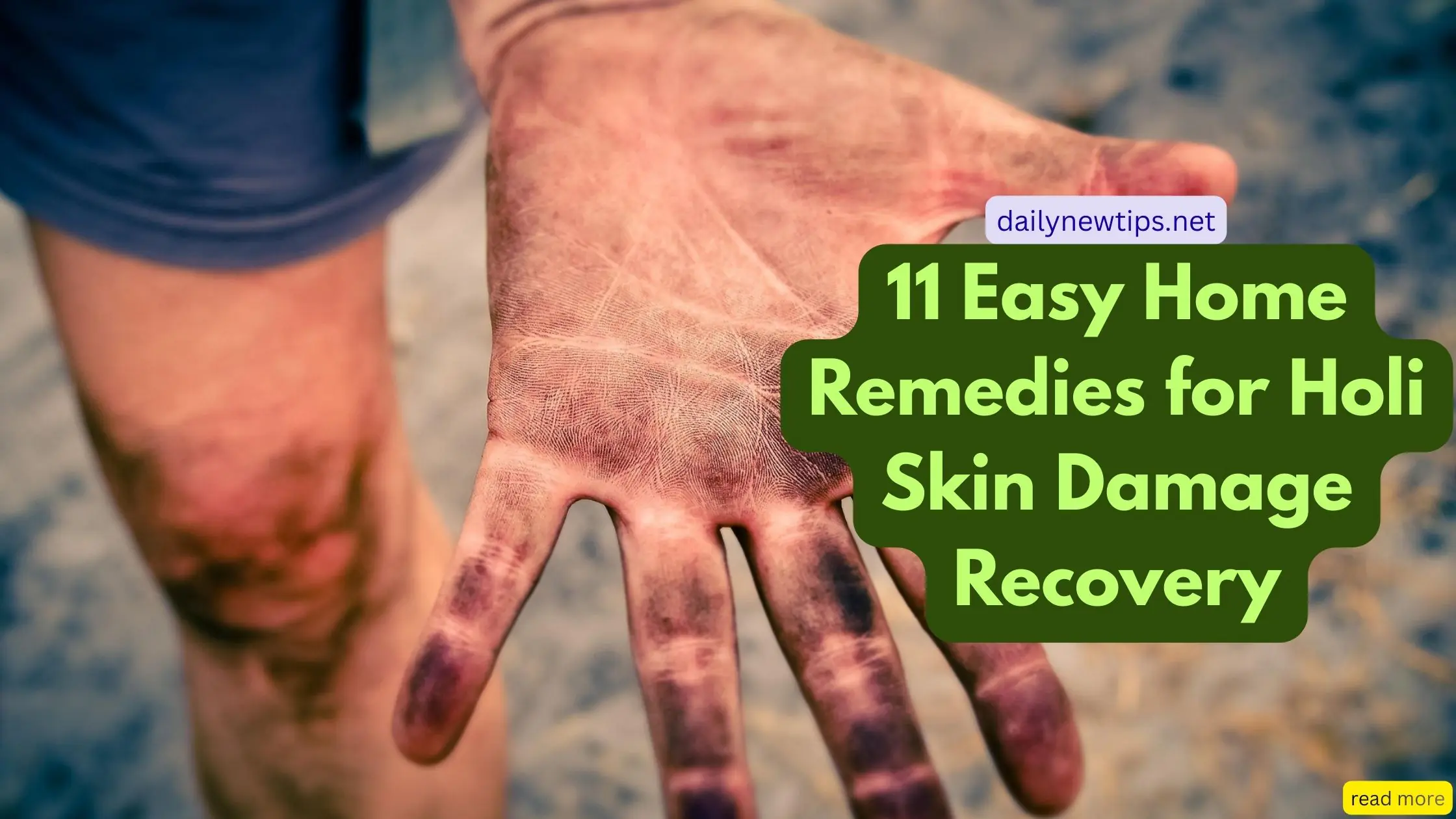 11 Easy Home Remedies for Holi Skin Damage Recovery